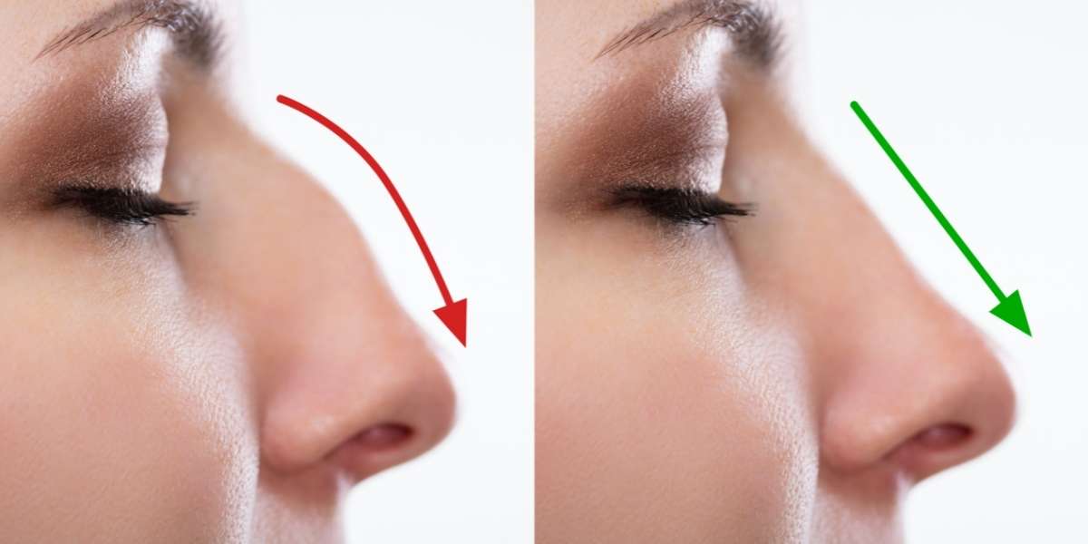 RhinoCorrect: rimodella il tuo naso senza chirurgia