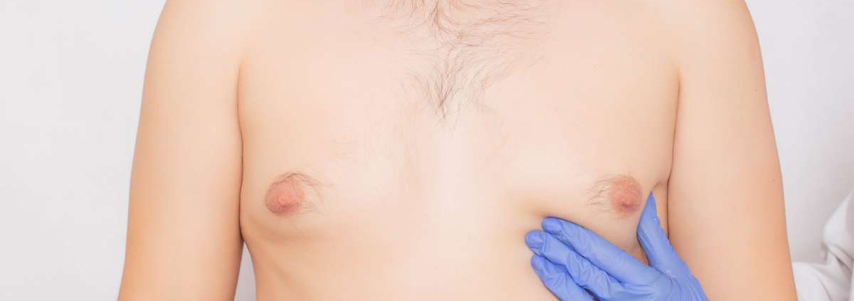 Pseudoginecomastia o lipomastia
