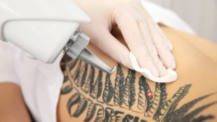 Rimozione tatuaggi: come intervenire?