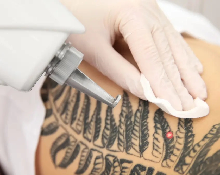 Rimozione tatuaggi: come intervenire?