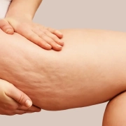 Carbossiterapia, la soluzione contro la cellulite e adiposità localizzate