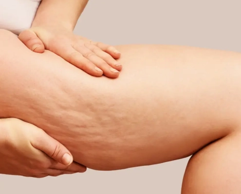 Carbossiterapia, la soluzione contro la cellulite e adiposità localizzate