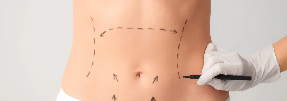 Addominoplastica: quando è indicata, come si esegue e tempi di recupero