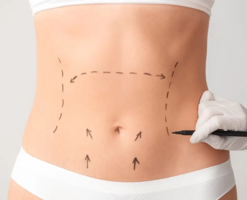 Addominoplastica: quando è indicata, come si esegue e tempi di recupero