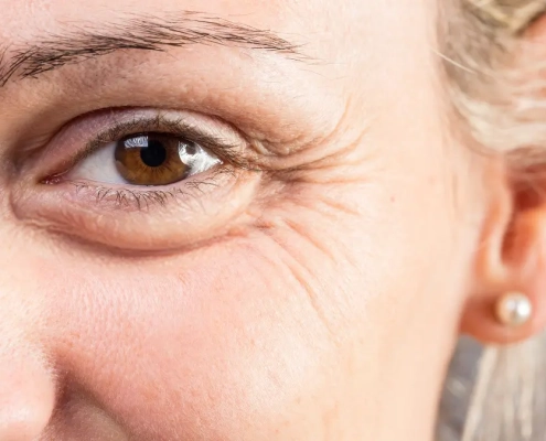 Blefaroplastica: ringiovanire lo sguardo in sicurezza